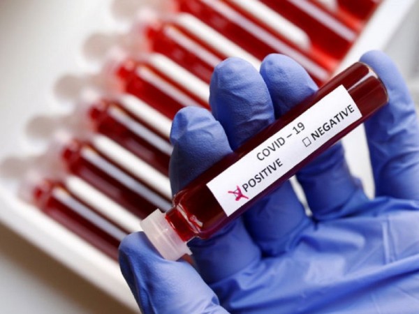 Оренбуржцам сообщили о пятерых умерших от коронавируса за сутки