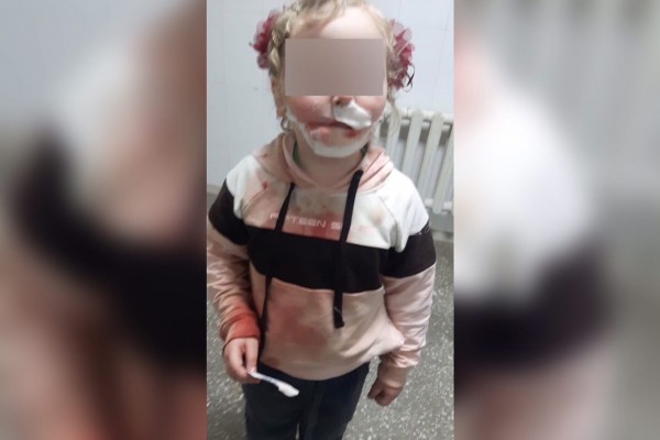 
В Новотроицке бродячая собака откусила губу 6-летней девочке		